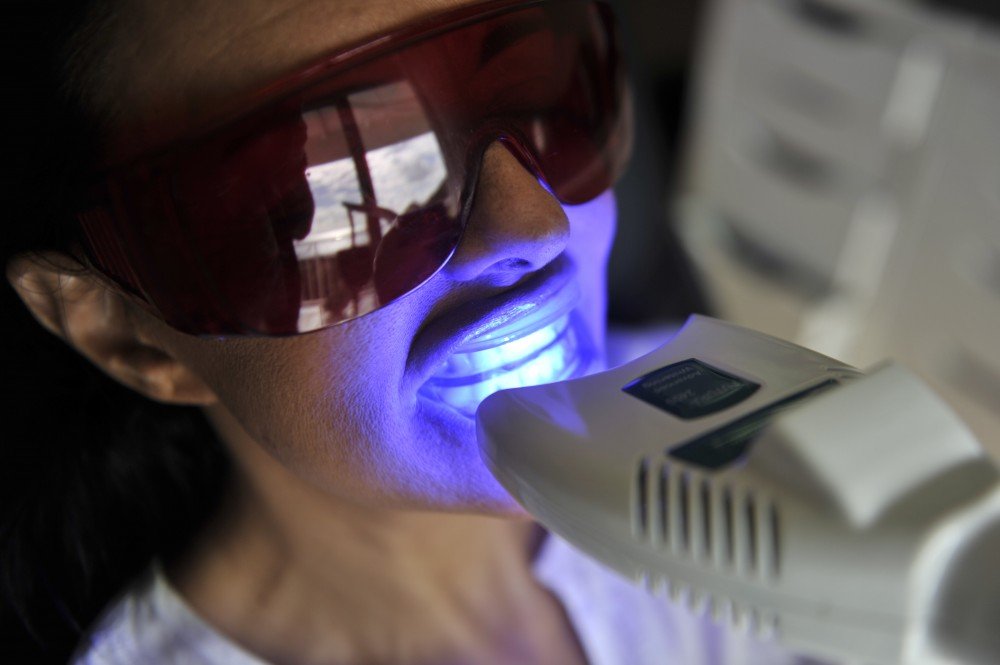 Laser Whitening